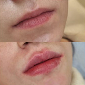 Контурна пластика губ
                    Косметологический центр  Ужгород