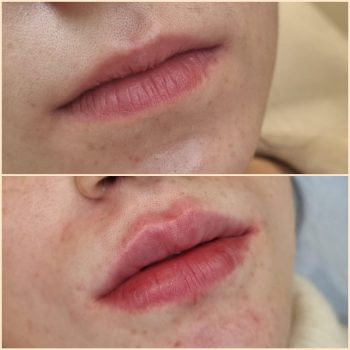 Контурна пластика губ
                    Косметологический центр  Ужгород