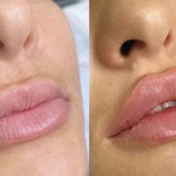 Контурна пластика губ
                    Косметологический центр  Ужгород