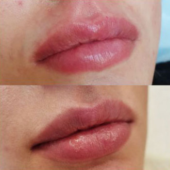 Контурна пластика губ
                    Косметологический центр  Ужгород