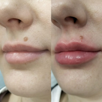 Контурна пластика губ
                    Косметологический центр  Ужгород