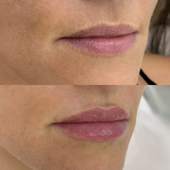 Контурна пластика губ
                    Косметологический центр  Ужгород