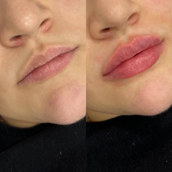 Контурна пластика губ
                    Косметологический центр  Ужгород