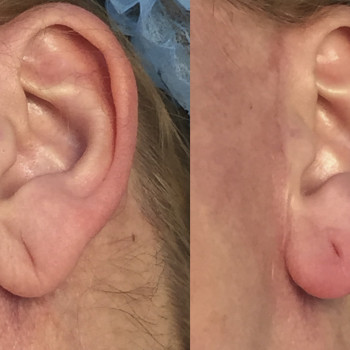 Контурна пластика мочки вуха
                    Косметологический центр  Ужгород