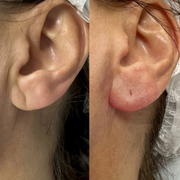 Контурна пластика мочки вуха
                    Косметологический центр  Ужгород