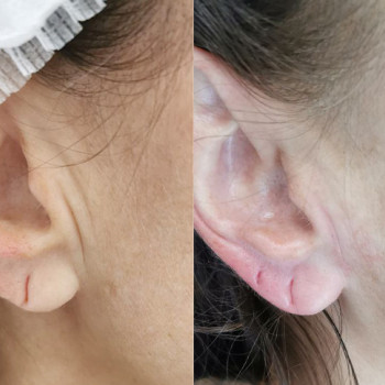 Контурна пластика мочки вуха
                    Косметологический центр  Ужгород