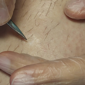 Електроепіляція
                    Косметолог Юлия Київ