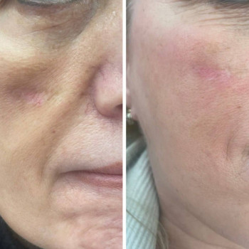 Екзосоми ін'єкції для обличчя, тіла, волосся
                    Косметологический центр  Ужгород