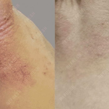 Екзосоми ін'єкції для обличчя, тіла, волосся
                    Косметологический центр  Ужгород