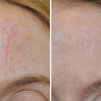 Екзосоми ін'єкції для обличчя, тіла, волосся
                    Косметологический центр  Ужгород