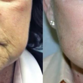 Бланшинг зморшок
                    Косметологический центр  Ужгород