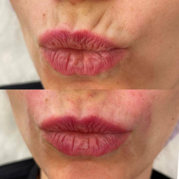 Бланшинг зморшок
                    Косметологический центр  Ужгород