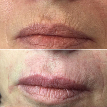 Бланшинг зморшок
                    Косметологический центр  Ужгород