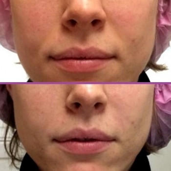 Бланшинг зморшок
                    Косметологический центр  Ужгород