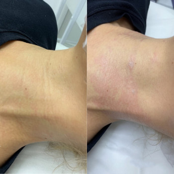 Бланшинг зморшок
                    Косметологический центр  Ужгород