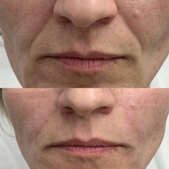 Бланшинг зморшок
                    Косметологический центр  Ужгород