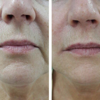 Бланшинг зморшок
                    Косметологический центр  Ужгород