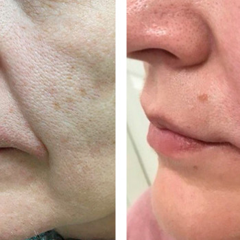 Бланшинг зморшок
                    Косметологический центр  Ужгород