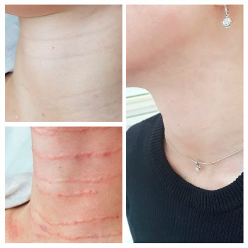 Бланшинг зморшок
                    Косметологический центр  Ужгород