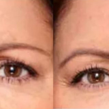 Ботулотоксин міжбрів'я
                    Косметологічний центр  Ужгород