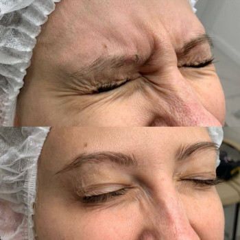 Ботулотоксин міжбрів'я
                    Косметологічний центр  Ужгород