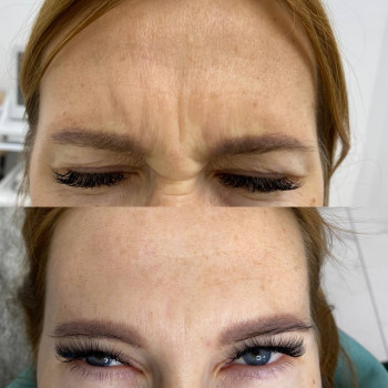 Ботулотоксин міжбрів'я
                    Косметологічний центр  Ужгород