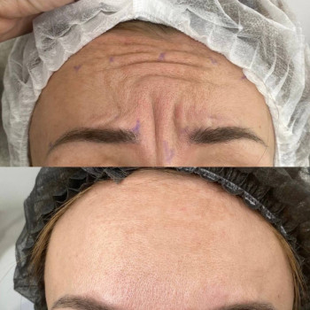 Ботулотоксин міжбрів'я
                    Косметологічний центр  Ужгород