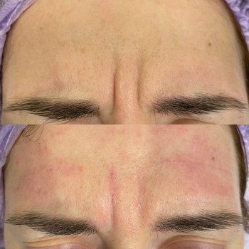 Ботулотоксин міжбрів'я
                    Косметологічний центр  Ужгород