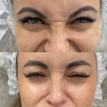 Ботулотоксин міжбрів'я
                    Косметологічний центр  Ужгород