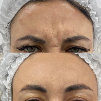 Ботулотоксин міжбрів'я
                    Косметологічний центр  Ужгород