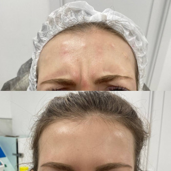 Ботулотоксин міжбрів'я
                    Косметологічний центр  Ужгород