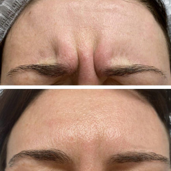 Ботулотоксин міжбрів'я
                    Косметологічний центр  Ужгород