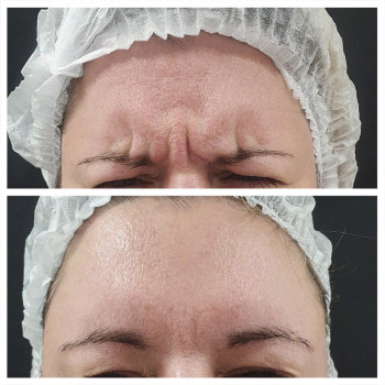 Ботулотоксин міжбрів'я
                    Косметологічний центр  Ужгород