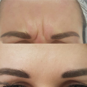 Ботулотоксин міжбрів'я
                    Косметологічний центр  Ужгород