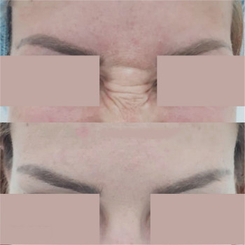 Ботулотоксин міжбрів'я
                    Косметологічний центр  Ужгород