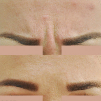 Ботулотоксин міжбрів'я
                    Косметологічний центр  Ужгород