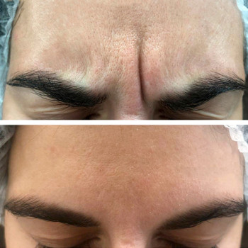 Ботулотоксин міжбрів'я
                    Косметологічний центр  Ужгород