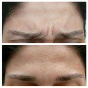 Ботулотоксин міжбрів'я
                    Косметологічний центр  Ужгород