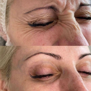 Ботулотоксин міжбрів'я
                    Косметологічний центр  Ужгород