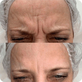 Ботулотоксин міжбрів'я
                    Косметологічний центр  Ужгород