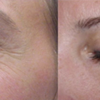 Ботулотоксин периорбітальної зони (очі, гусячі лапки)
                    Косметологічний центр  Ужгород