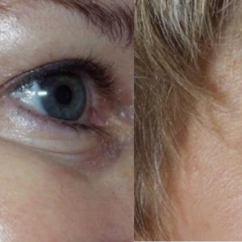 Ботулотоксин периорбітальної зони (очі, гусячі лапки)
                    Косметологічний центр  Ужгород