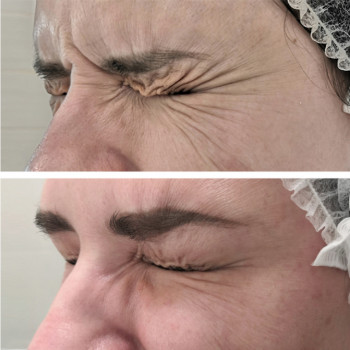 Ботулотоксин периорбітальної зони (очі, гусячі лапки)
                    Косметологічний центр  Ужгород