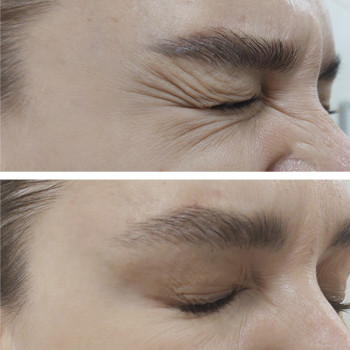 Ботулотоксин периорбітальної зони (очі, гусячі лапки)
                    Косметологічний центр  Ужгород