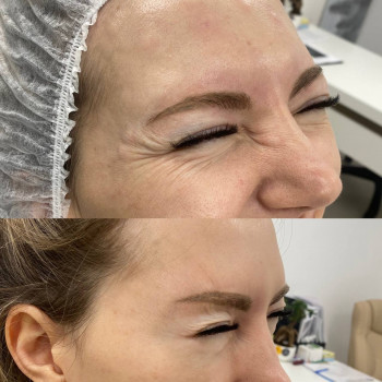 Ботулотоксин периорбітальної зони (очі, гусячі лапки)
                    Косметологічний центр  Ужгород