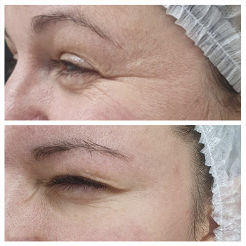 Ботулотоксин периорбітальної зони (очі, гусячі лапки)
                    Косметологічний центр  Ужгород