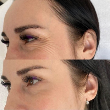 Ботулотоксин периорбітальної зони (очі, гусячі лапки)
                    Косметологічний центр  Ужгород