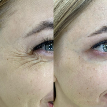 Ботулотоксин периорбітальної зони (очі, гусячі лапки)
                    Косметологічний центр  Ужгород