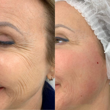 Ботулотоксин периорбітальної зони (очі, гусячі лапки)
                    Косметологічний центр  Ужгород