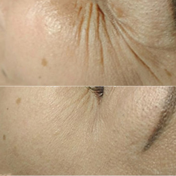 Ботулотоксин периорбітальної зони (очі, гусячі лапки)
                    Косметологічний центр  Ужгород